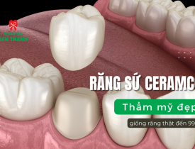 Răng sứ Ceramco - Thẩm mỹ đẹp, giống răng thật đến 99%